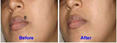 Mole Removal Before and After Results